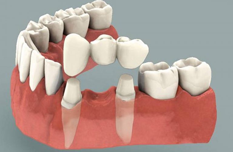 dental-bridges